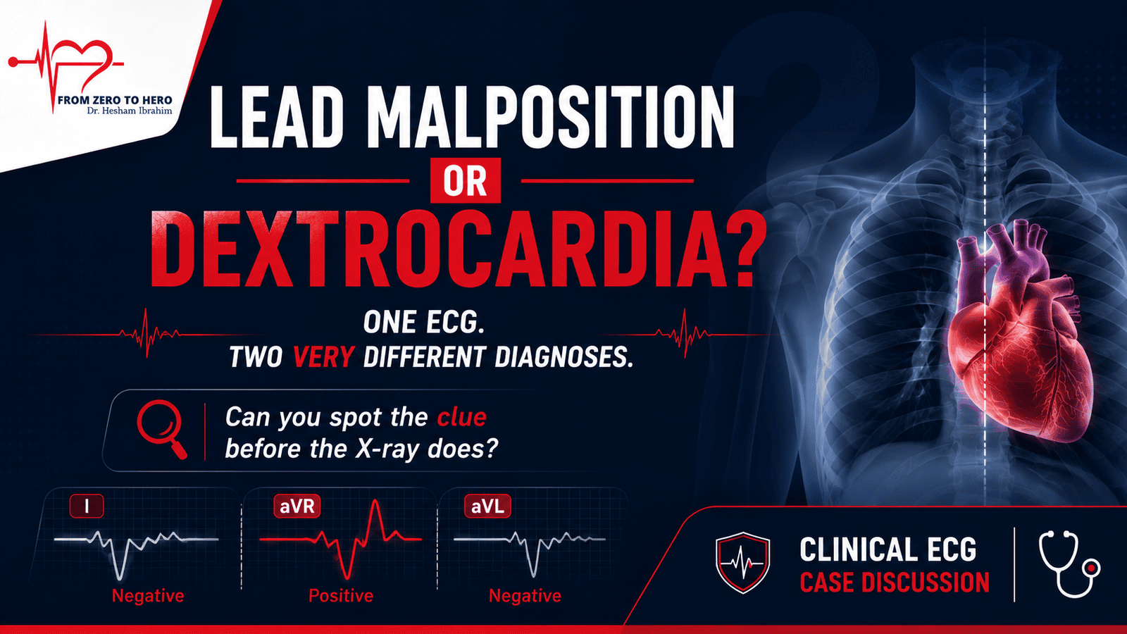 Lead Malposition vs Dextrocardia: ECG Clues to Tell Them Apart